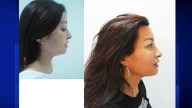 Procedure Defines, Tightens Skin on Neck