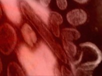 Teen Swine Flu Patient Dies