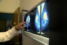 New Mammogram Guidelines Worry Some Health Pros