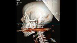Woman Survives Being Shot Through Mouth with Harpoon