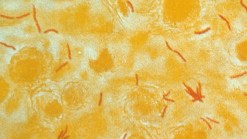 Tuberculosis Reported at Md. High School