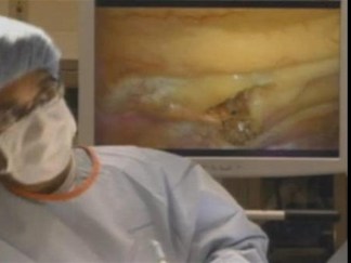Doctors Remove Lung Tumors Through Two Holes