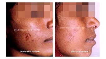Best Ways to Banish Scars