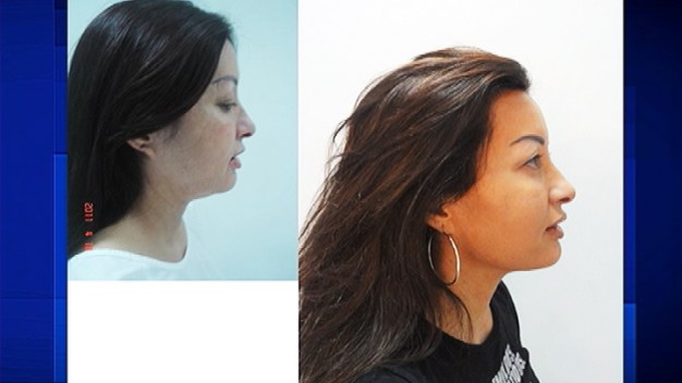 Procedure Defines, Tightens Skin on Neck