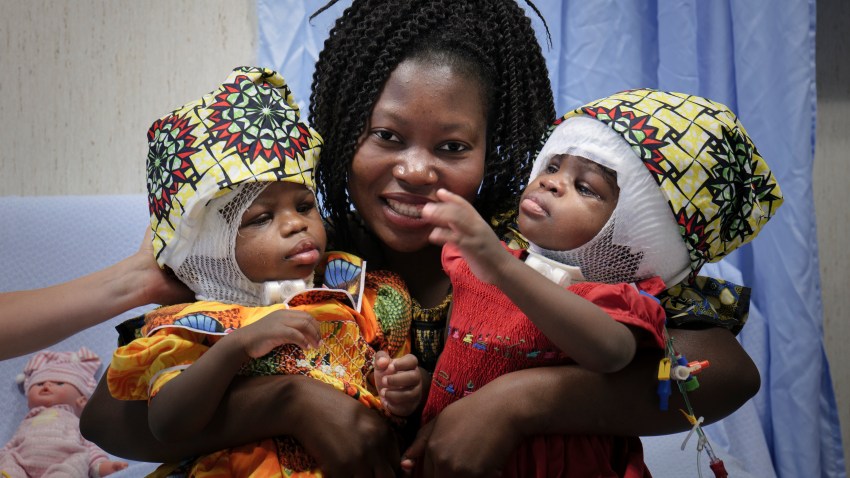 Ermine holds her twins Ervina and Prefina, at the Vatican pediatric hospital, in Rome, June 30, 2020. Doctors at the Vatican’s pediatric hospital said Tuesday, July 7, 2020 they have successfully separated conjoined twins whose skulls were fused back-to-back, an exceedingly rare surgery for an equally rare congenital defect. Twins Ervina and Prefina Bangalo were born June 29, 2018 in Mbaiki, Central African Republic sharing the same skull and critical blood vessels around their brains.