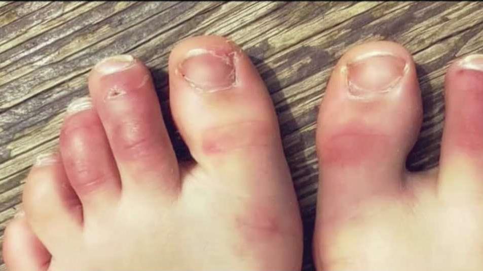 Covid toe after vaccine
