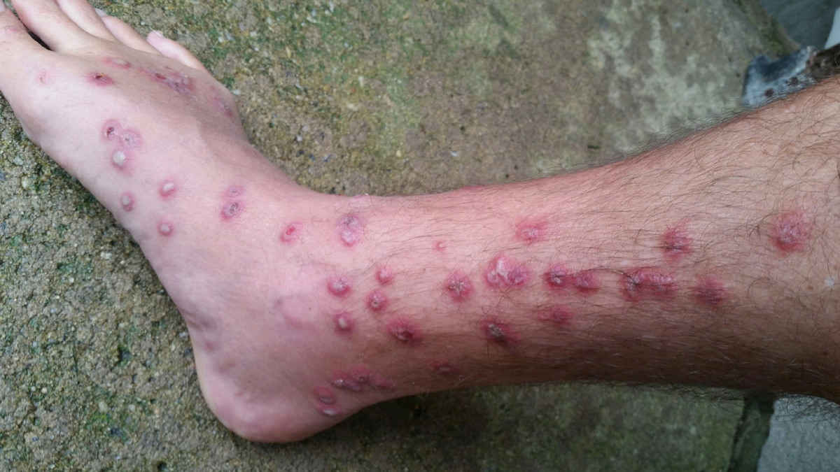 infected swimmers itch