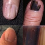 nail-melanoma-today-square-190408_910ede9535c926304e70ed57aaaf936a.fit-560w