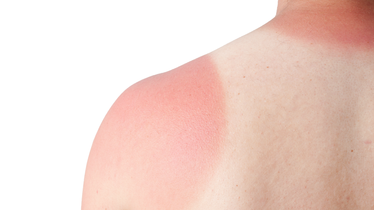 Practice Safe Sun to Avoid Heat Rash, Photosensitivity and Body Odor