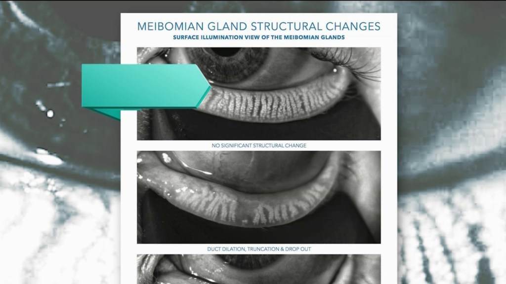 Face Masks Can Cause Dry Eyes, Doctors Say Here’s How To Get Relief
