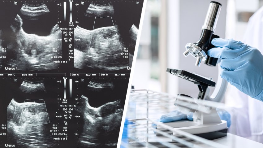 Understanding Priapism – NBC4 Washington