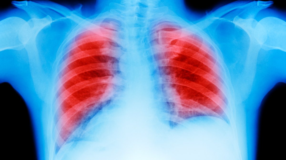 Double Lung Transplants Saves 2 Late-Stage Cancer Patients – NBC4 Washington - Vimarsana News