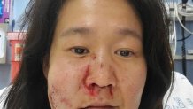 Nasu suffered multiple facial injuries after the attack, including three fractures in her nose, one cheek fracture and broken teeth.