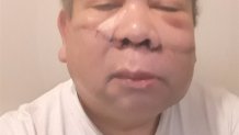 Quintana's right cheek was slashed by a stranger on a New York City subway