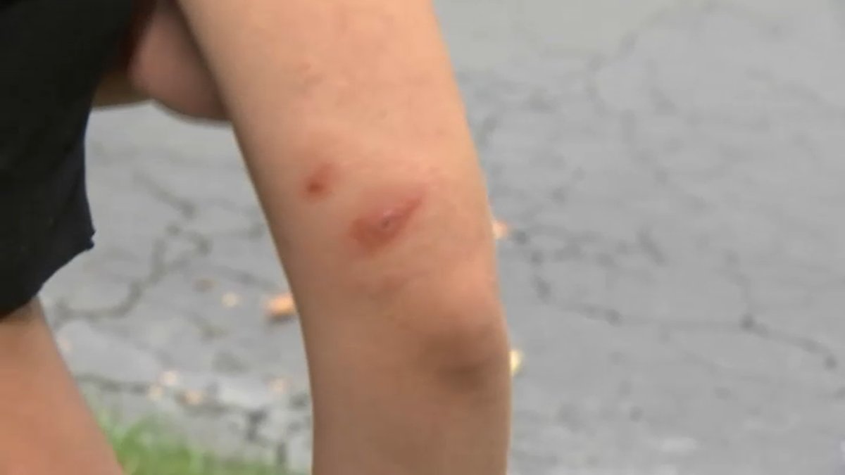 mosquito bites on legs