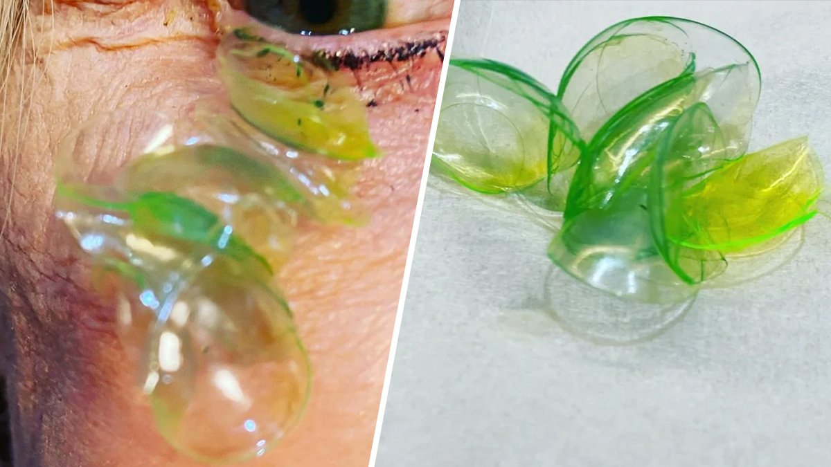 Woman Had 23 Contact Lenses Stuck Under Her Eyelid, Doctor Says – NBC4 Washington - Vimarsana News