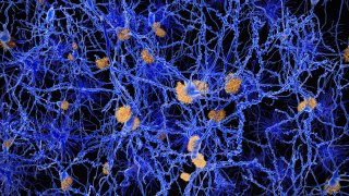Amyloid plaques accumulate outside neurons. Amyloid plaques are characteristic features of Alzheimer’s disease. They lead to a degeneration of the affected neurons.