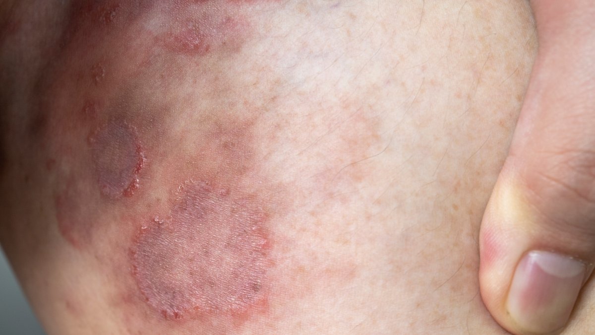 First Resistant Ringworm Infections Detected in United States – NBC4 Washington - Vimarsana News