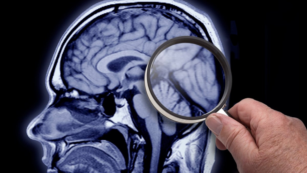 Health insurance companies may not cover new Alzheimer's drug Leqembi – NBC4 Washington - Vimarsana News