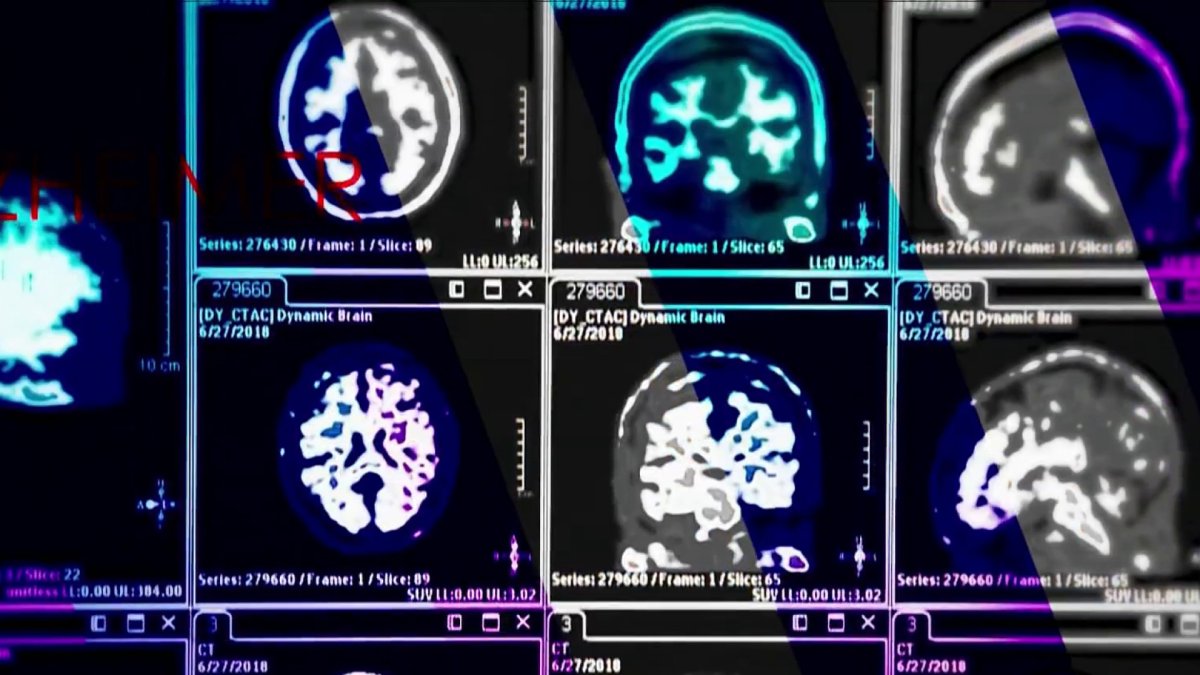‘New era’ Blood test may be able to detect Alzheimer’s NBC4 Washington