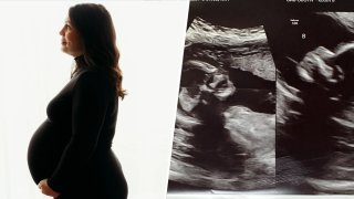 Kelsey Hatcher beside the sonogram of her rare double pregnancy.