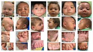 Six babies from the Nemours analysis in a photo published in an article in Genetics in Medicine Open, by Erin Wadman, et al., “A novel syndrome associated with prenatal fentanyl exposure.”