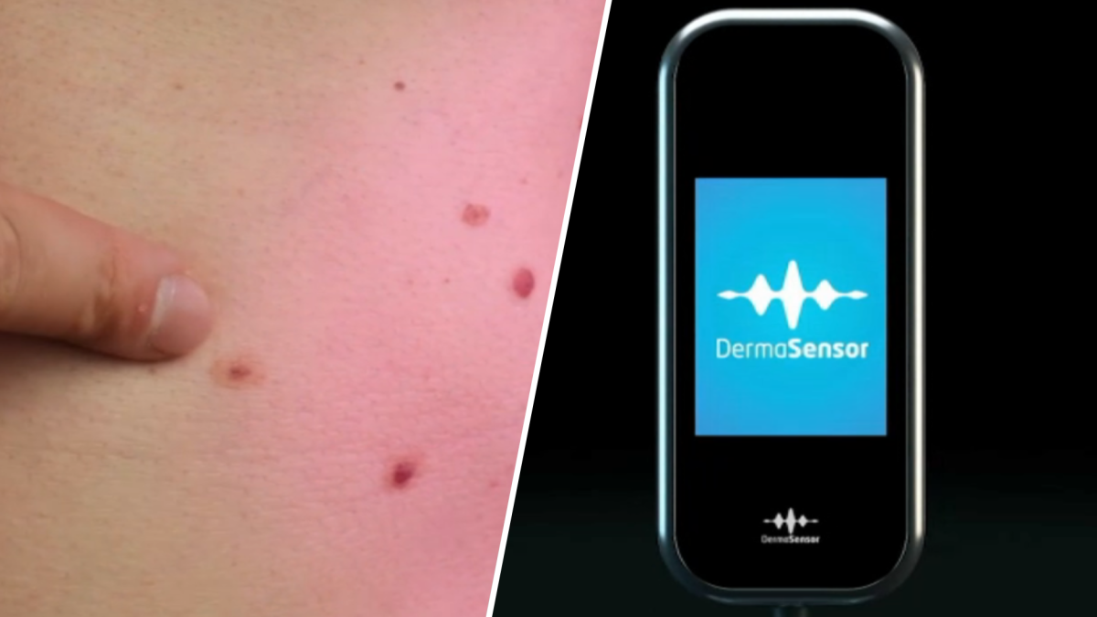 Comment un appareil d’IA de la taille d’un téléphone détecte le cancer de la peau – NBC4 Washington