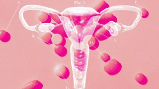 After nearly a century of disagreements over what, exactly, defines the condition, as well as a lack of research, PCOS is still poorly understood. The symptoms are so varied that any single drug would be unlikely to help all patients, doctors say.