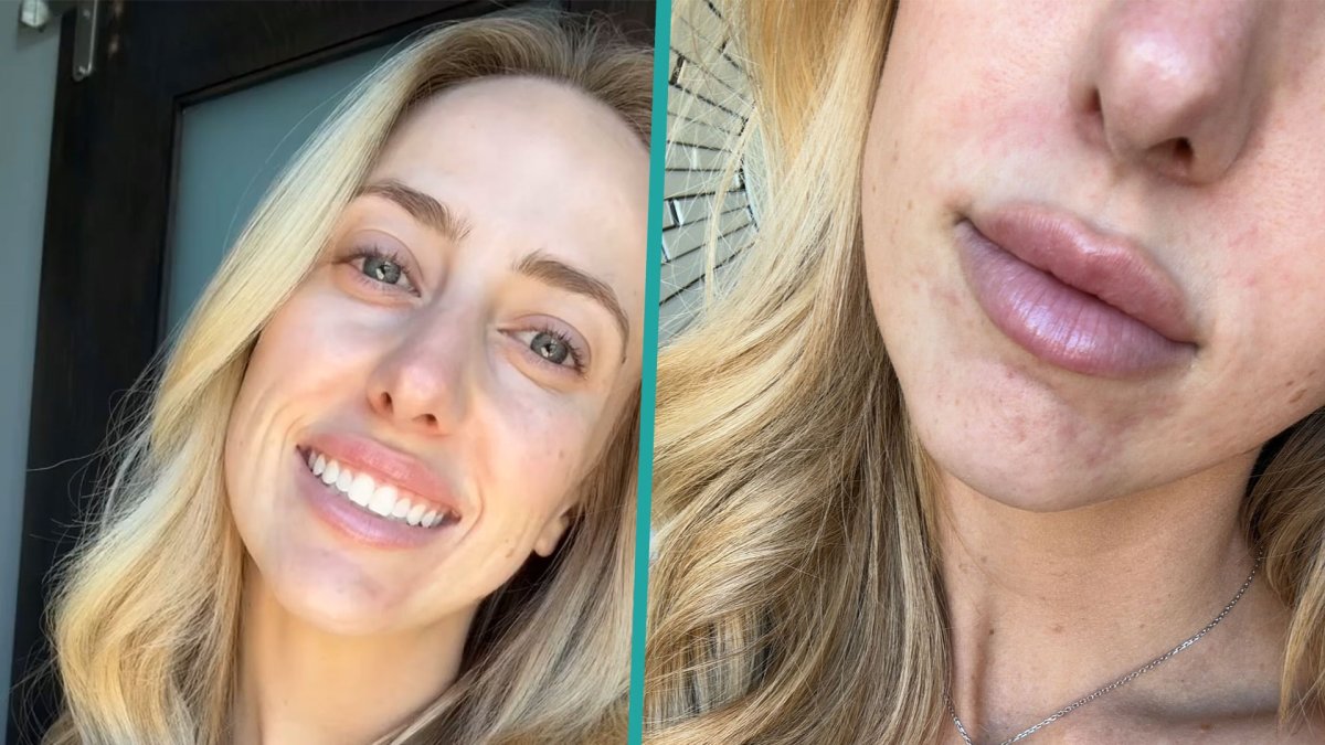 Brittany Mahomes gets real about flaring acne in makeupless selfies