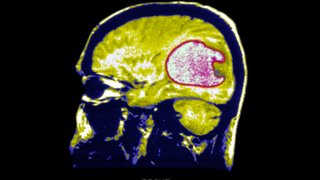 Mri T1. Glioblastoma. A Nodulus Of The Cerebellum Protrudes Into The Cystic Cavity.