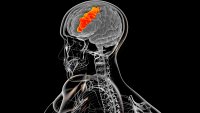 Bilingual AI brain implant helps stroke survivor communicate in Spanish and English