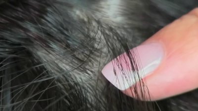 The debate over treating head lice in schools