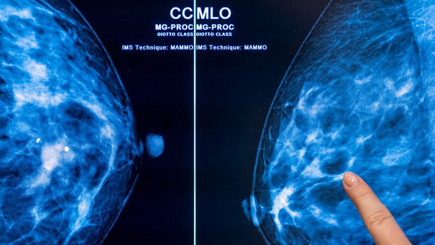 25 February 2022, Berlin: Medical personnel use a mammogram to examine a woman’s breast for breast cancer. Photo: Hannibal Hanschke/dpa (Photo by Michael Hanschke/picture alliance via Getty Images)