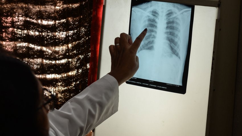 A doctor checks the chest X-ray of a patient in the tuberculosis