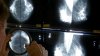 Cancer before age 50 is increasing. A new study looks at which types