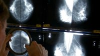 A radiologist uses a magnifying glass to check mammograms