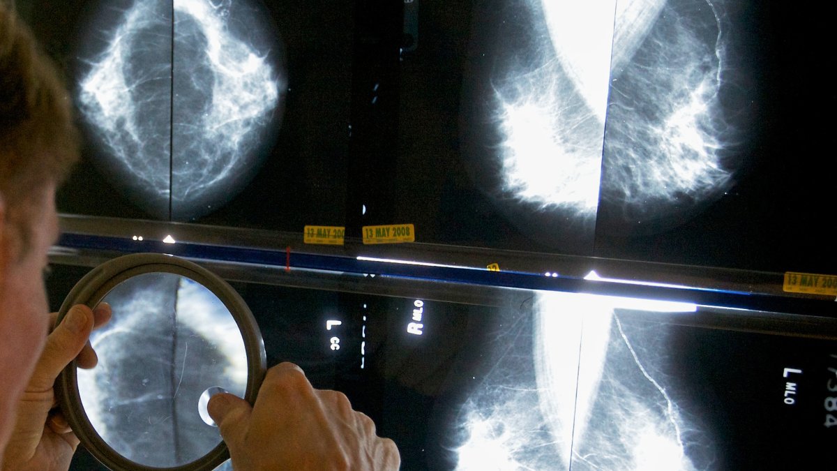 Pandemic disruptions to health care worsened cancer survival, study suggests