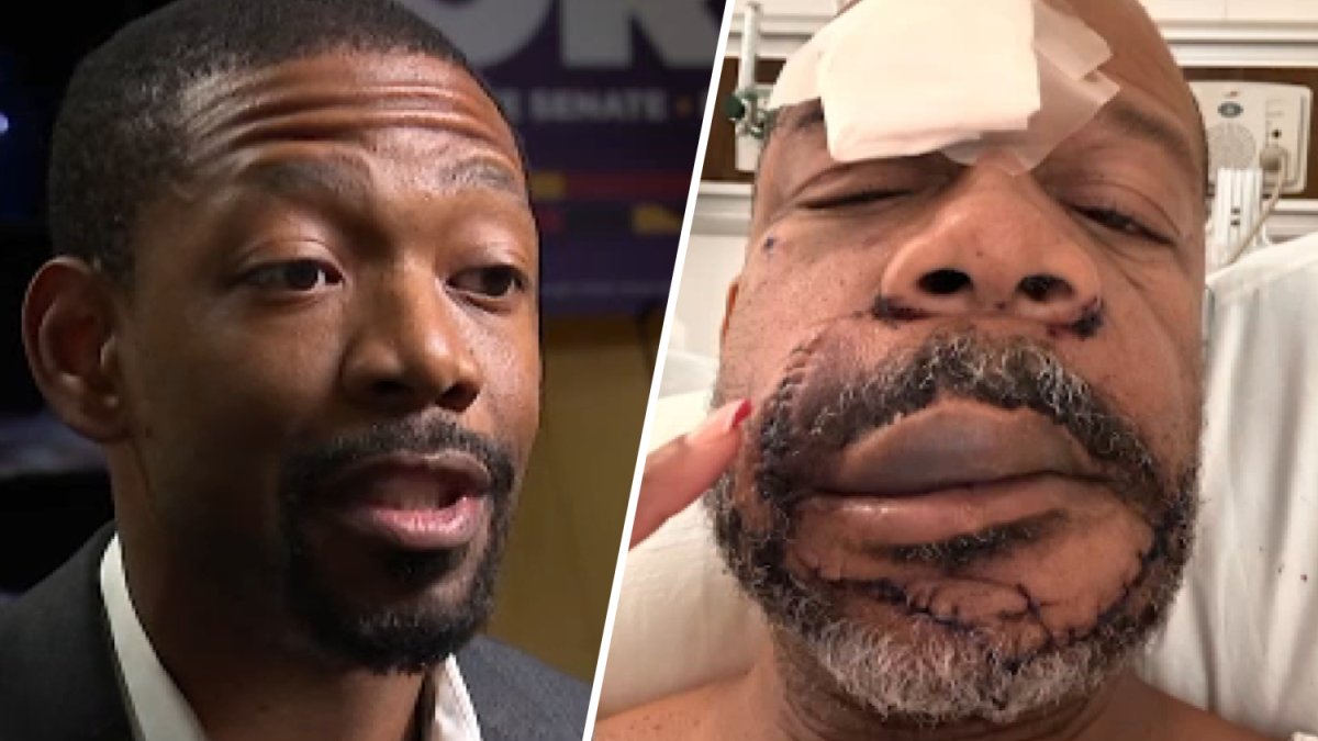 After bar fight on video, Maryland Senate candidate addresses dropped felony charges